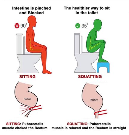 Grafik: Sitzen auf der Toilette knickt den Enddarm ab, in der Hocke ist er gerade und frei